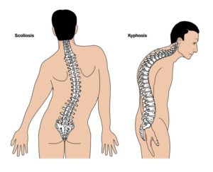 kyphosis_scoliosis